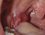 tonsil-cancer1 tonsil-cancer1