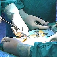 hymenoplasty11 hymenoplasty11