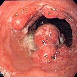 Esophageal_adenoca