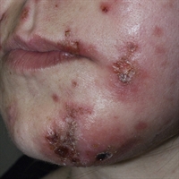 mrsa fun!