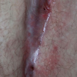 600px-Two_pilonidal_cysts_in_the_natal_cleft