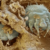 Scabies: My Parting Gift from Los Angeles' Metro Jail